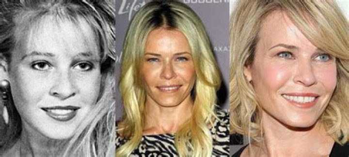 Chelsea Handler Plastic Surgery Before and After