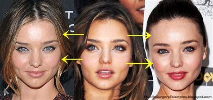 Miranda Kerr Plastic Surgery Before and After